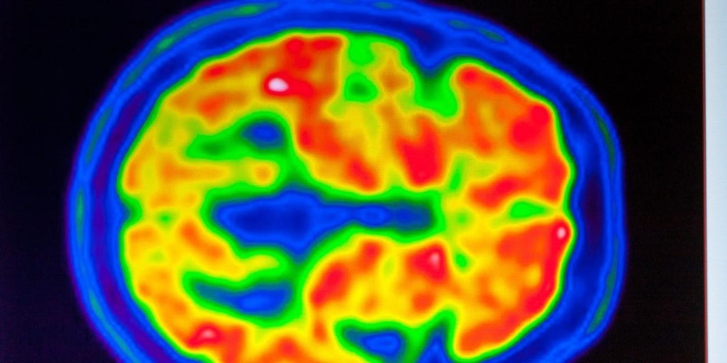 Cuándo sospechar de alzhéimer, más allá de la pérdida de memoria