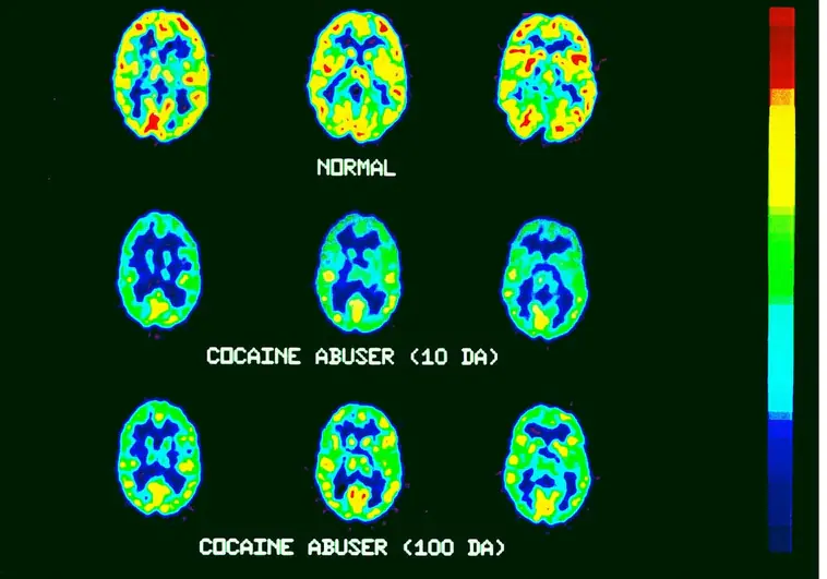 Así altera la cocaína  los genes del cerebro