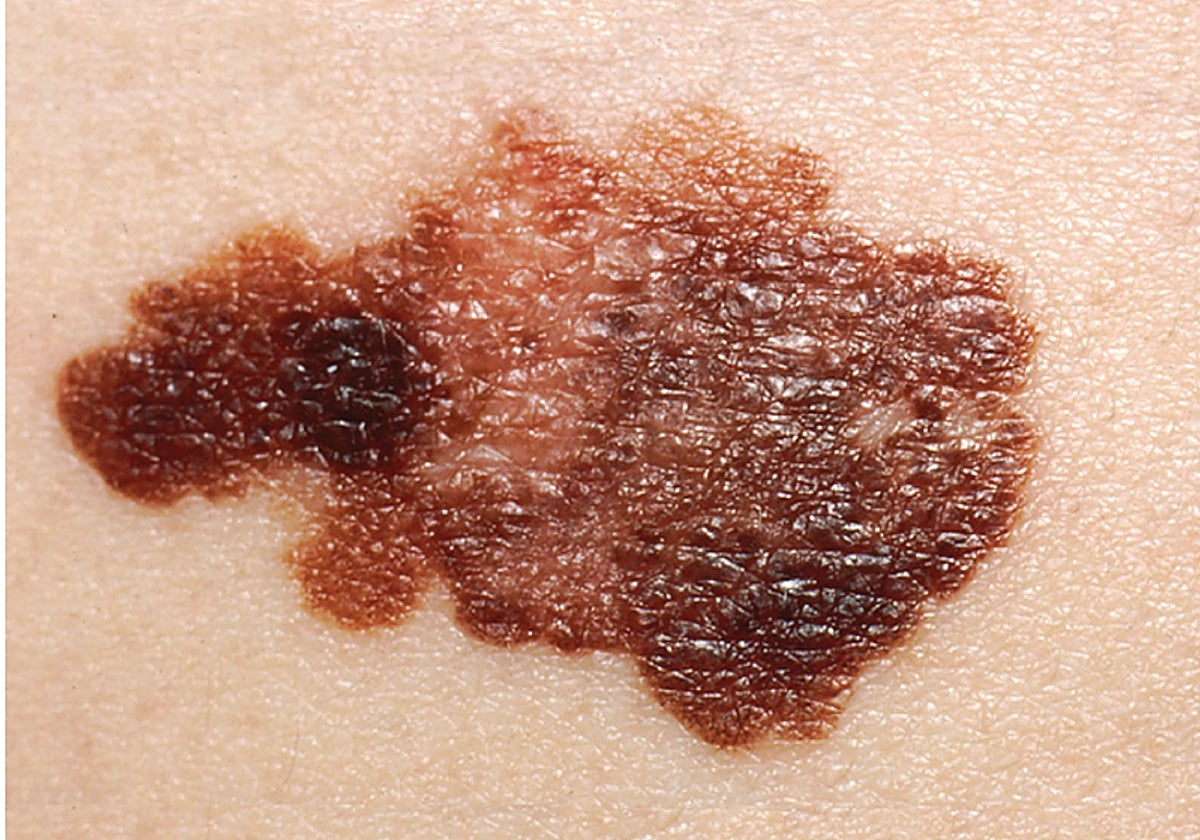 Melanoma