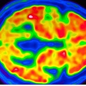 Alzheimer y colesterol, una relación tóxica