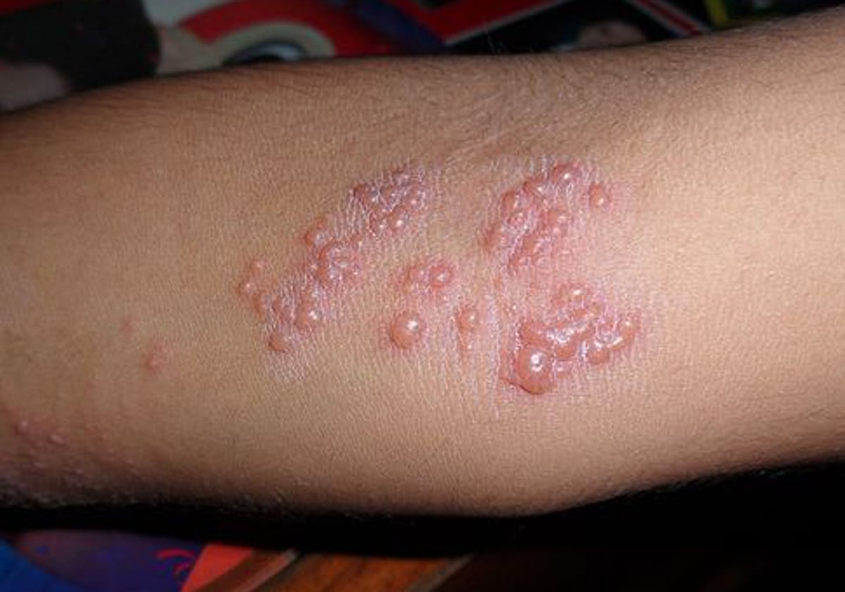 Erupción cutánea causada por el herpes zóster