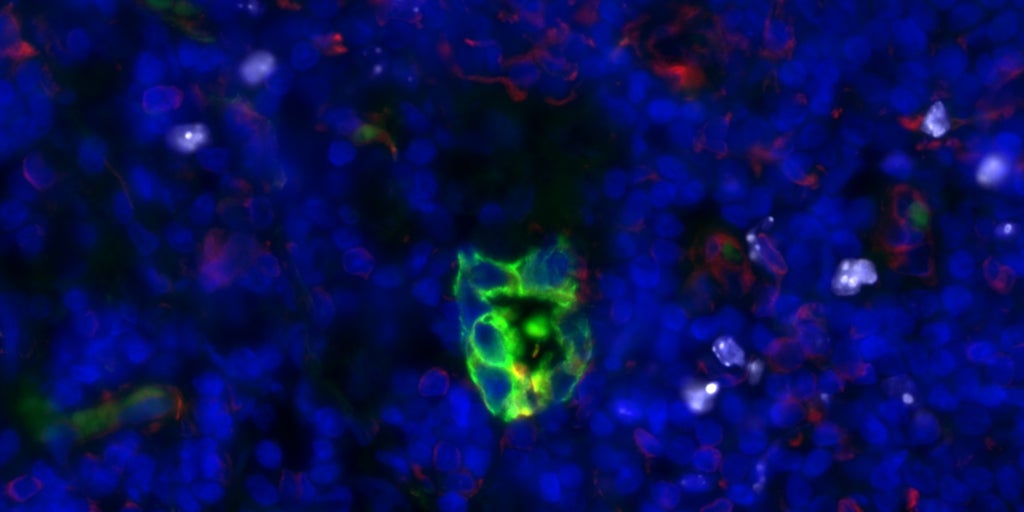 Identificar una estratagia potencial contra la metástasis