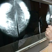 Una molécula activa los cánceres de mama inexplicables por el modelo clásico