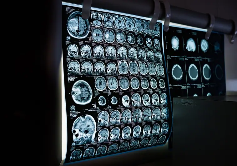 Cáncer de cerebro Resonancia-cerebral-RjCKVQaoTmrOkAYtfBk9OvO-758x531@abc