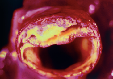 La aterosclerosis acelera el envejecimiento en jóvenes