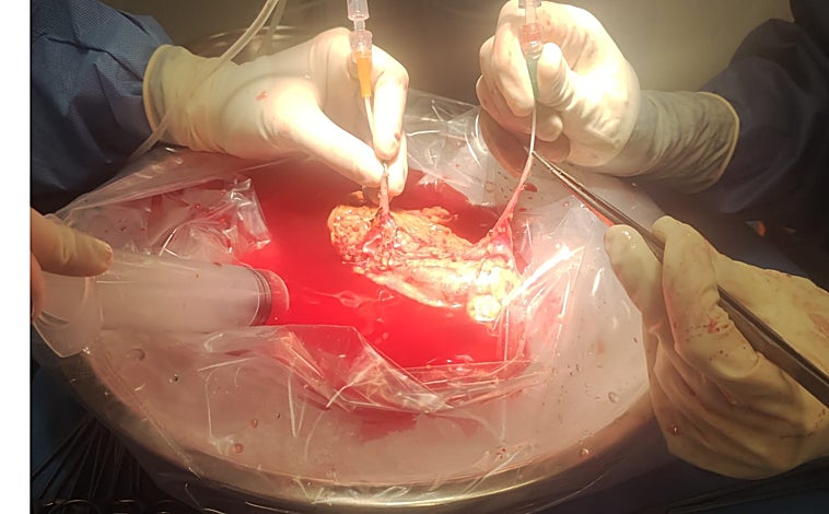 Imagen principal - Los cirujanos extraen el riñón en el Hospital de Padua y lo manipulan para su conservación. Los profesionales del Hospital de Cruces tienen el envío del riñón preparado que, tras un viaje en avión se entrega en la ciudad italiana de Padua.