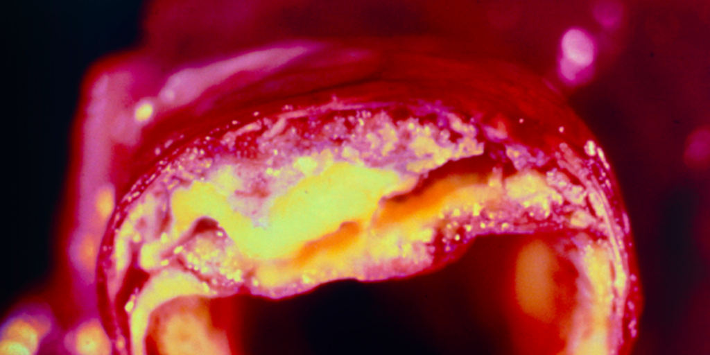 Algunas bacterias intestinales facilitan los depósitos de grasa en las arterias del corazón