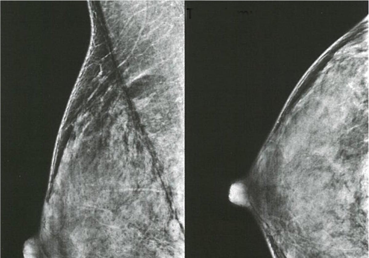 Dos imágenes de mamografía