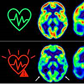 Explican la tóxica relación entre la aterosclerosis y el alzhéimer