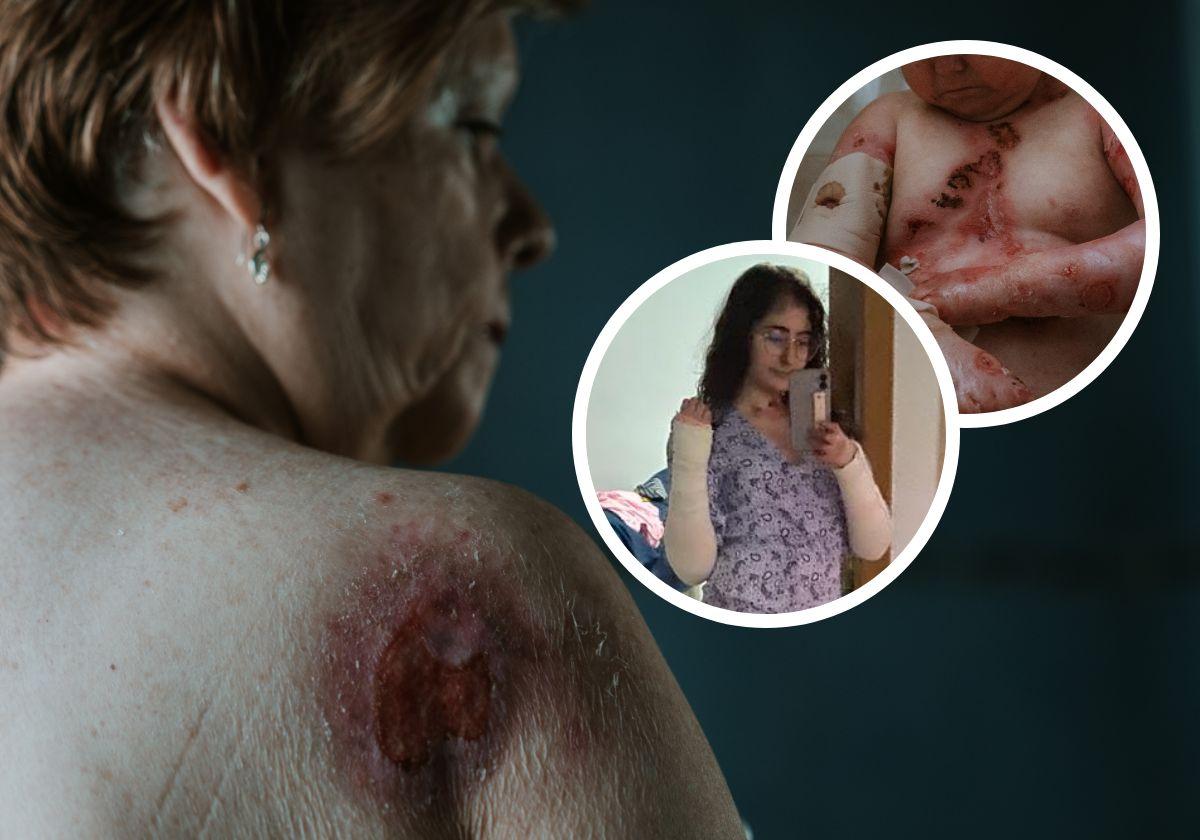 Varios afectados por la Piel de Mariposa. En el centro, Lucía