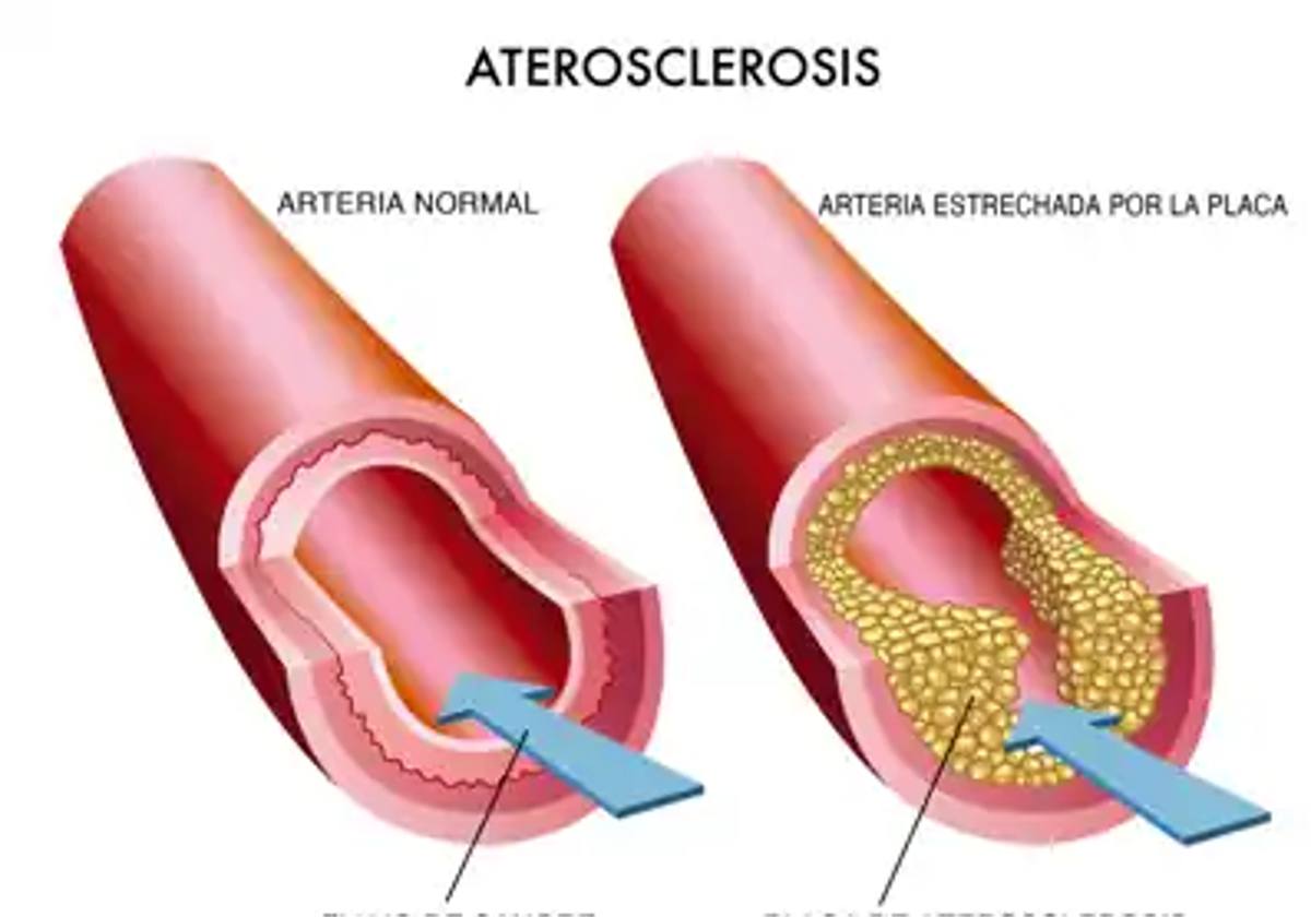 Efectos de la aterosclerosis