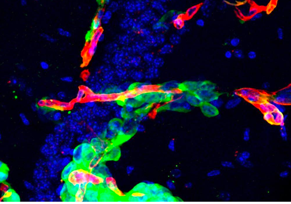 Células metastásicas en el cerebro (en verde)