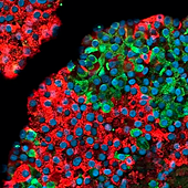 La muerte de dos pacientes suspende un ensayo con células madre para la diabetes