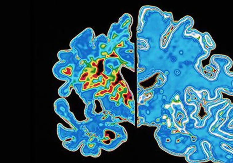 Asocian la terapia hormonal para el cáncer de mama con un menor riesgo de demencia