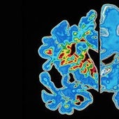 Asocian la terapia hormonal para el cáncer de mama con un menor riesgo de demencia