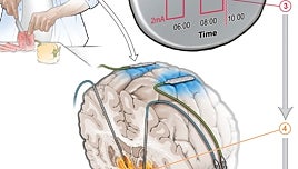 Un marcapasos inteligente controla los síntomas del párkinson de día y de noche