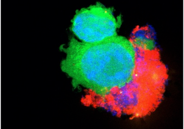 Cinco factores clave predicen la respuesta a la inmunoterapia en cáncer