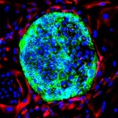 La terapia celular CAR-T combate un cáncer cerebral infantil incurable