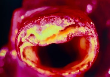 El amigo del colesterol que favorece la aterosclerosis y la enfermedad cardiovascular