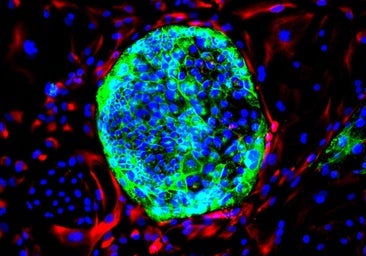 El cáncer de colon crece en personas jóvenes en todo el mundo menos en España