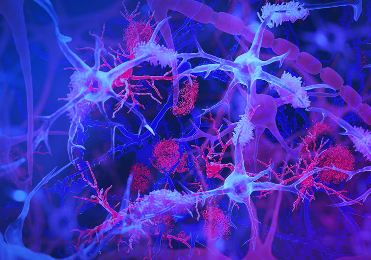 Hallan una relación entre la infección por citomegalovirus y el alzhéimer