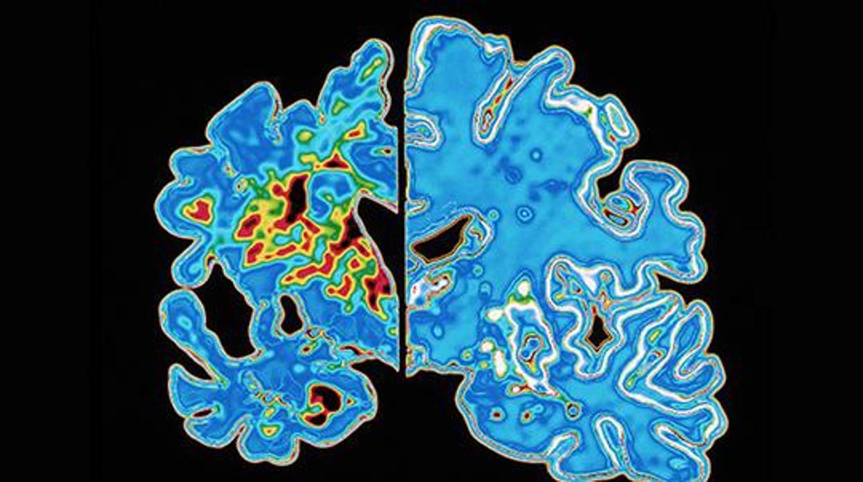 Imagen de un cerebro con placas de alzhéimer