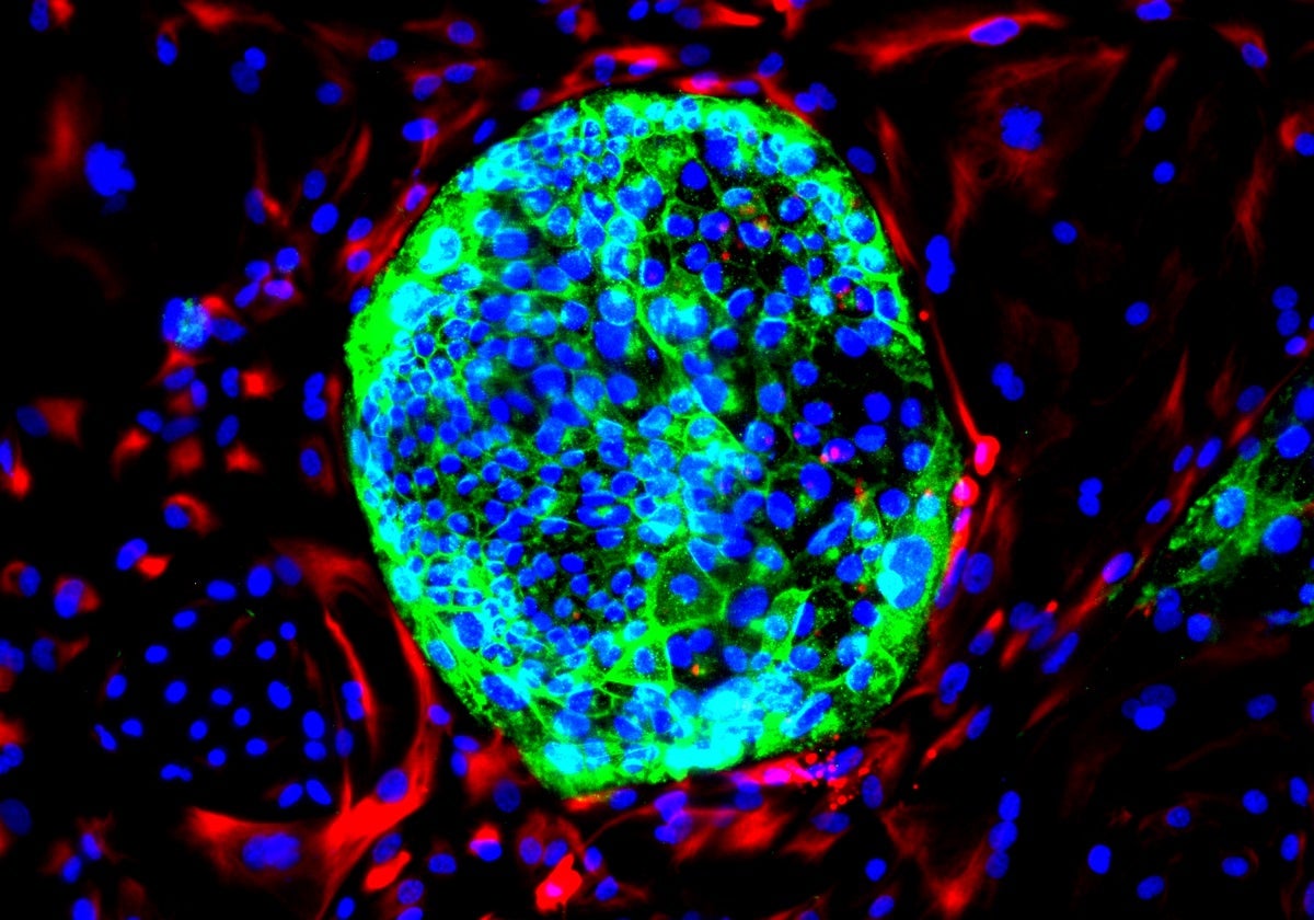 Prueban una terapia que disuelve células cancerosas en pacientes con metástasis