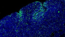 Una terapia innovadora detiene un tumor cerebral infantil antes de que se forme