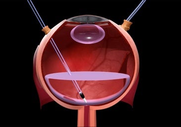 Un estudio en 10 pacientes demuestra la seguridad del trasplante celular degeneración macular