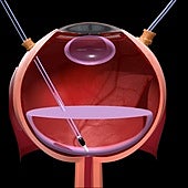 Un estudio en 10 pacientes demuestra la seguridad del trasplante celular degeneración macular