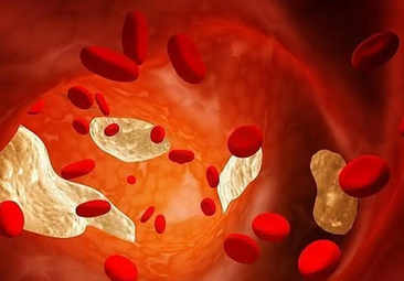 Imagen de placas de colesterol en sangre