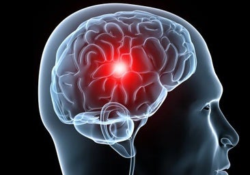 Qué hay detrás de los ictus inexplicables en menores de 50 años