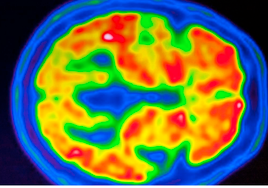 Esta terapia T-CAR para un cáncer cerebral agresivo en 18 pacientes