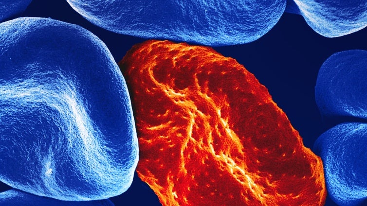 La bilirrubina protege frente a los efectos más graves de la malaria