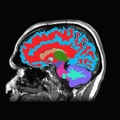 El escáner muestra las diferentes zonas del cerebro