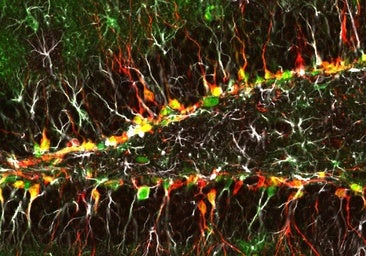 Un trasplante de médula ósea detiene una enfermedad rara en ocho pacientes