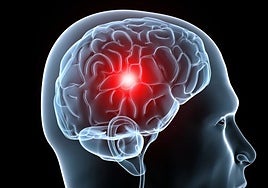 Estos son los 5 síntomas de alerta del ictus y así puedes prevenirlo