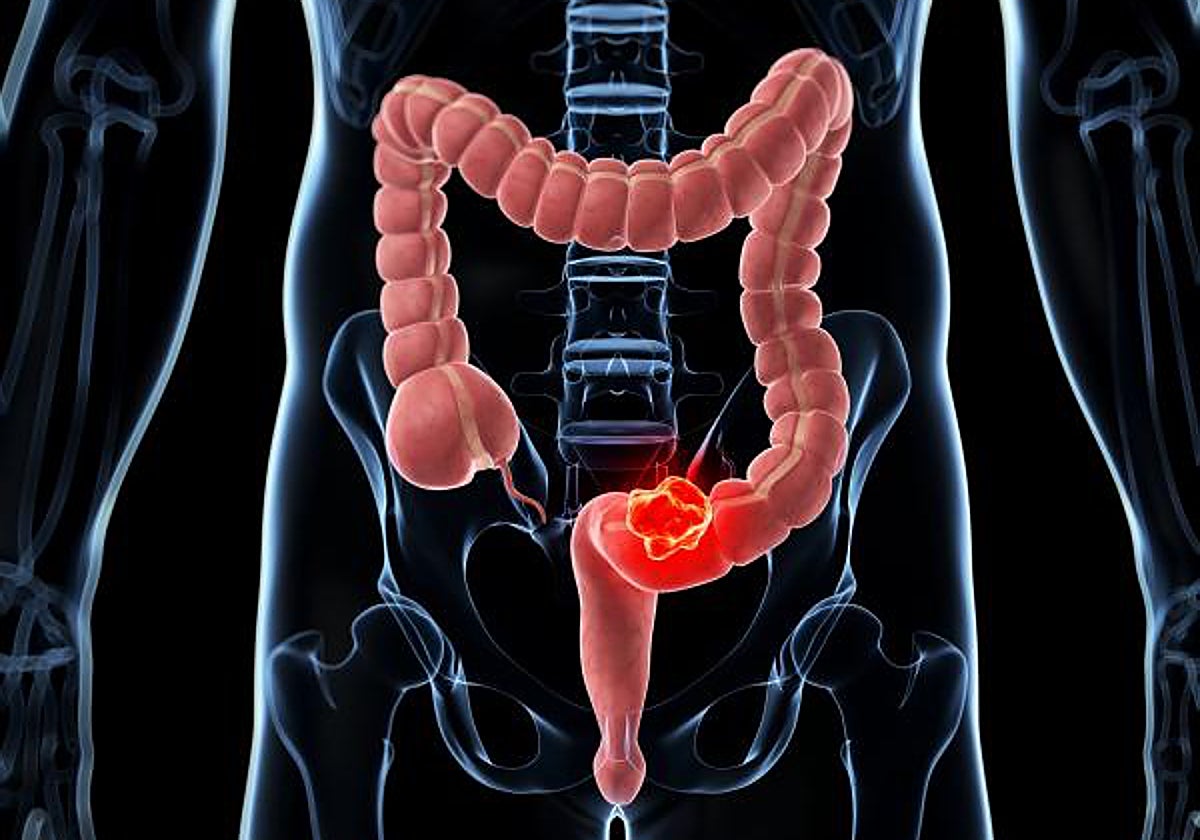 El cáncer colorrectal es el tumor más diagnosticado en España