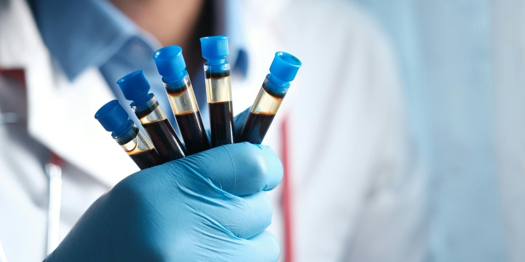 Un análisis de sangre identifica el riesgo temprano de padecer alzhéimer