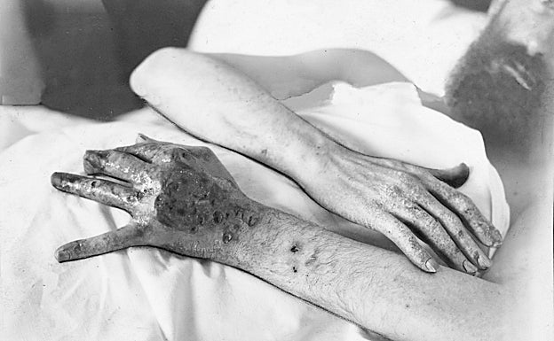 Las manos del médico mutiladas por las prácticas de radiología