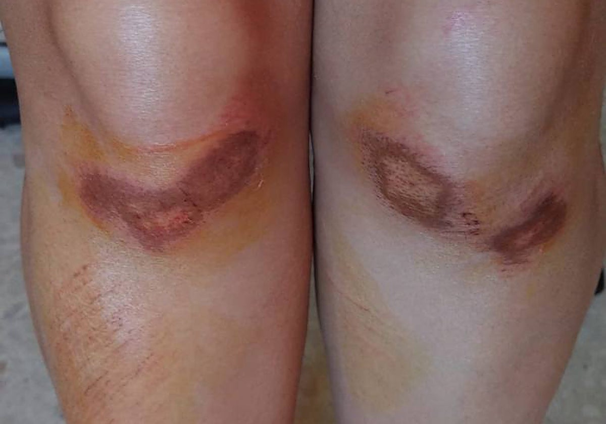 Así quedaron las rodillas de unas de las víctima tras ser arrastrada por las agresoras