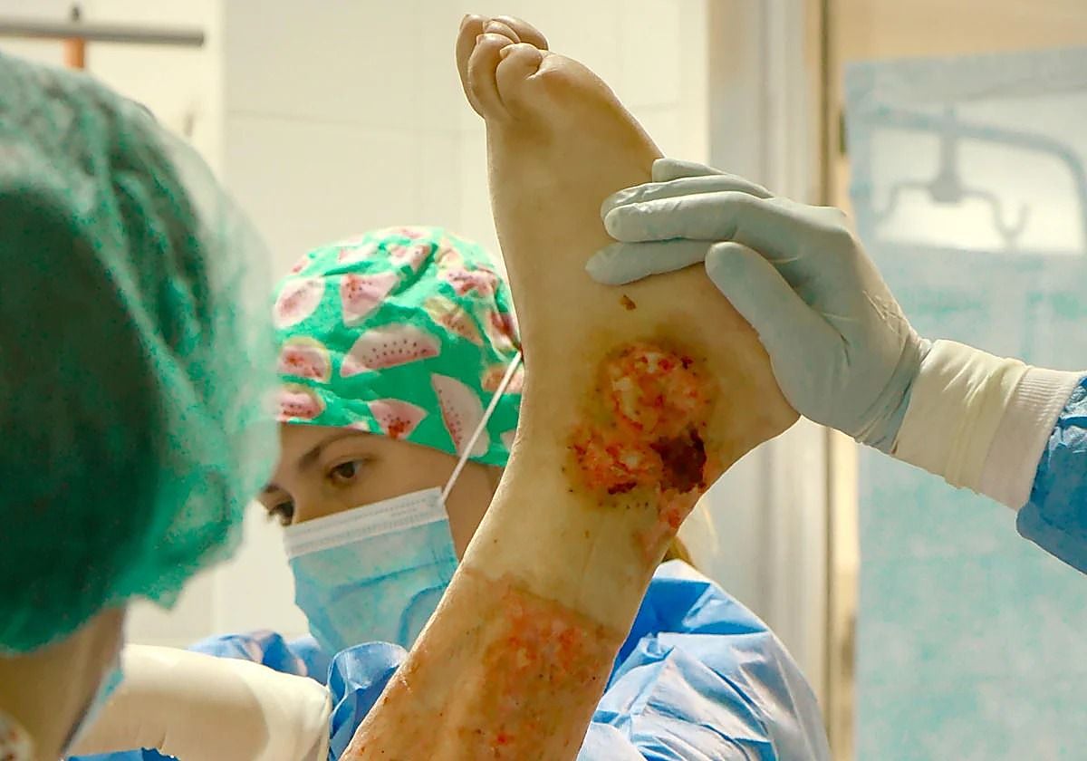 Profesionales de la Unidad de Quemados del Virgen del Rocío con un paciente