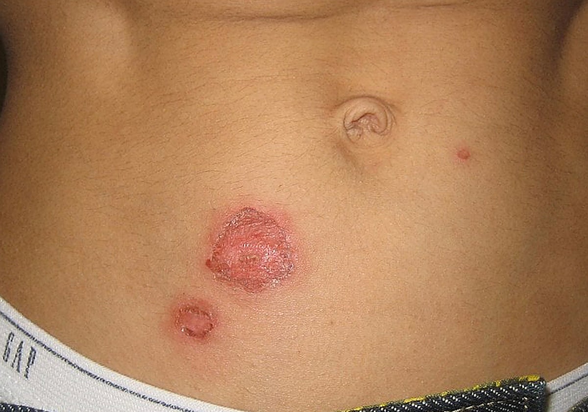 Una erupción típica del impétigo