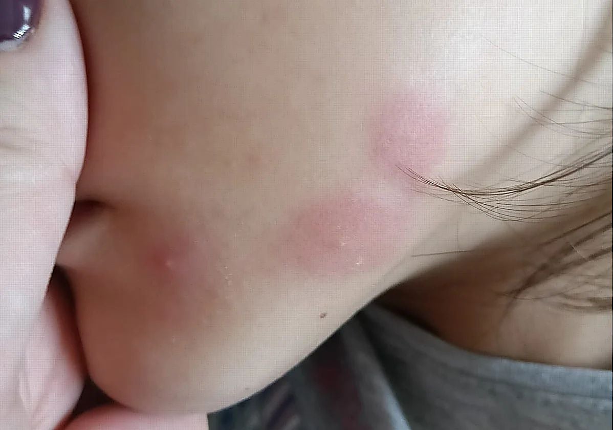 Una de las picaduras sufridas por el alumnado