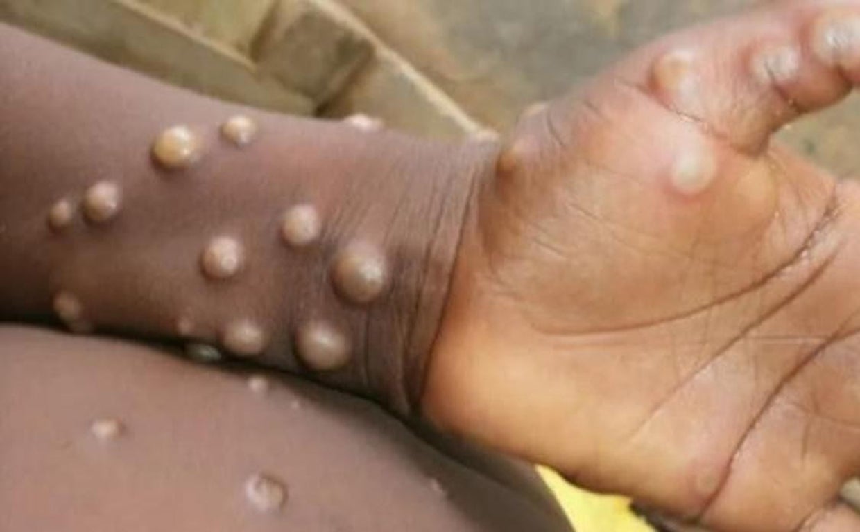 Imagen de parte de la sintomatología de la enfermedad