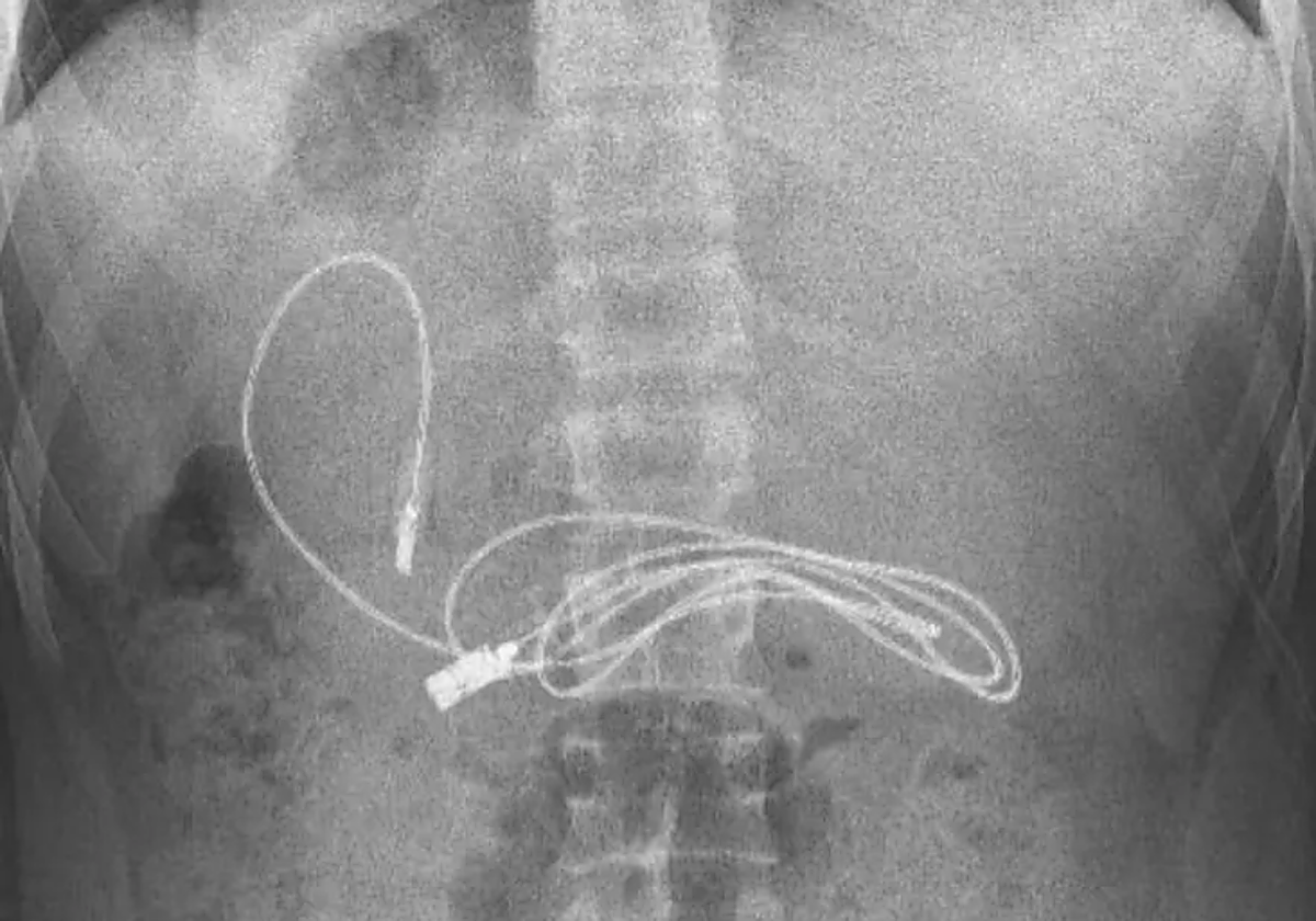 El terrible dolor de tripa de un adolescente que resultó estar causado el cargador de un metro que tenía en el estómago