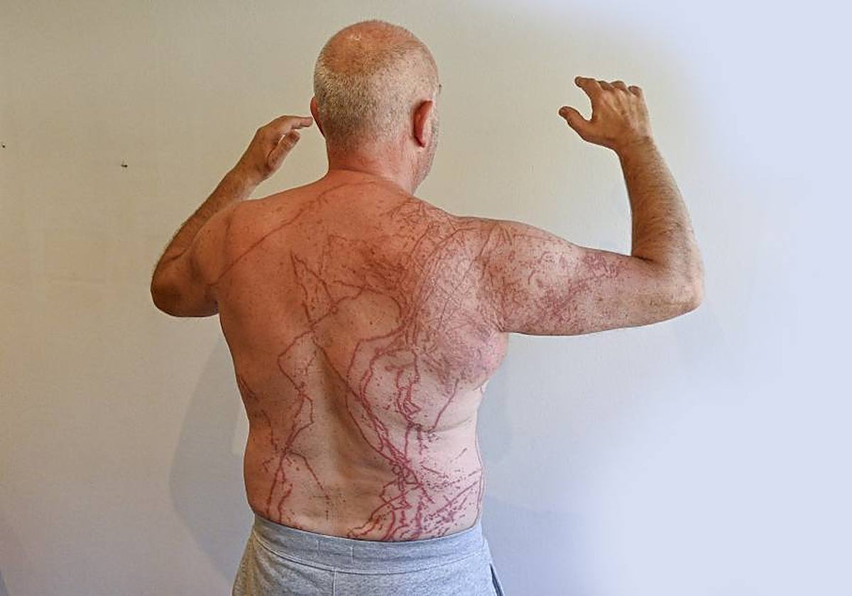Javier muestra las numerosas marcas en la espalda, axilas, piernas y brazo derecho provocadas por una picadura de carabela portuguesa el pasado martes en Ondarreta