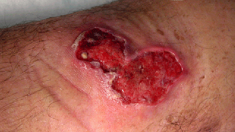 úlcera de Buruli en el brazo de un viajante de Senegal