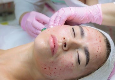 Tres mujeres se infectan de VIH después de realizarse un 'tratamiento facial vampiro'