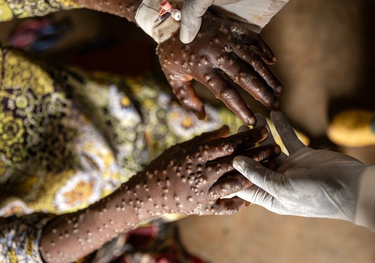 Imagen de un paciente con síntomas del virus mpox